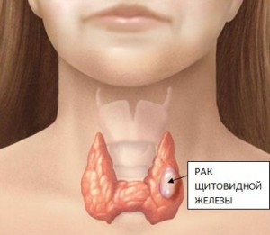 Новый метод лечения рака щитовидной железы thumbnail