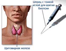 Биопсия