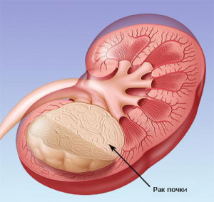 Рак почки