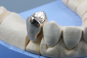 Металлические коронки зубов