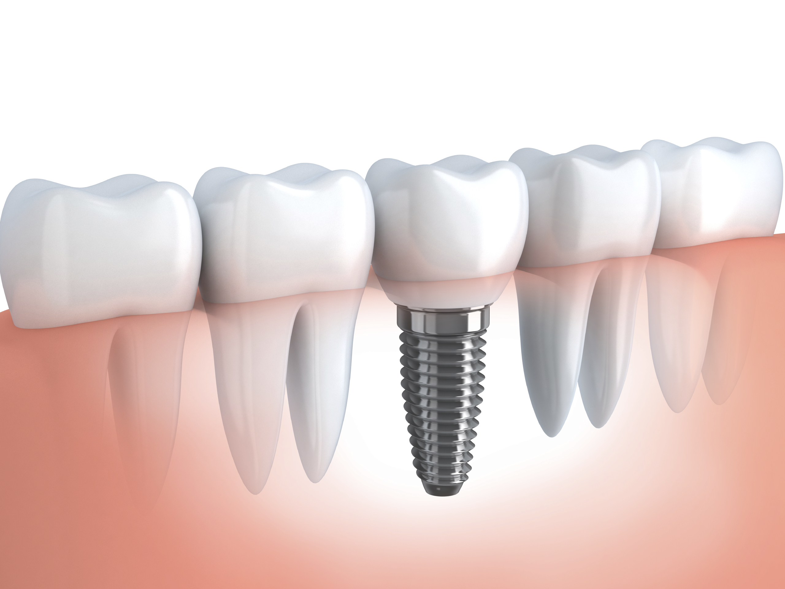 Рекомендации после имплантации зуба