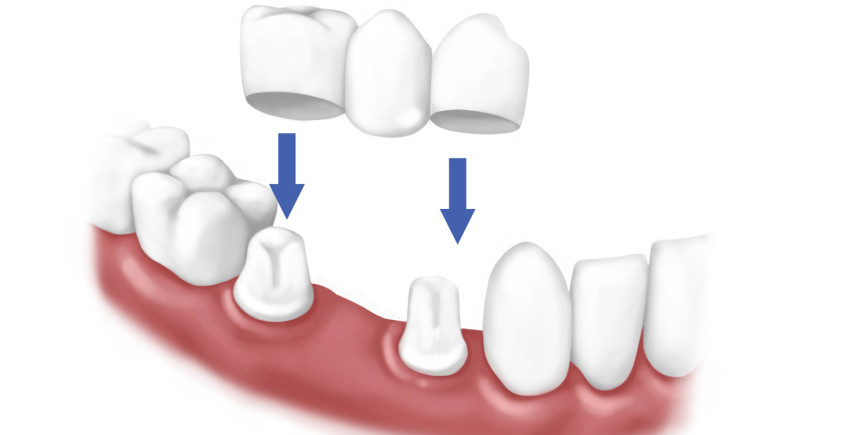 Виды зубных коронок