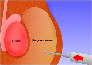 Лечение водянки