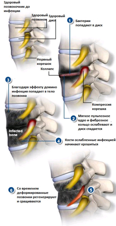 Если занесена инфекция в позвоночнике thumbnail