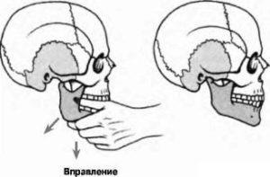 Подвывих нижней челюсти: симптомы и лечение, как правильно вправить челюсть, последствия