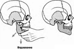 Лечение вывиха челюсти - вправление