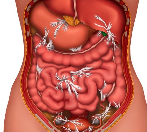 Спайки брюшной полости