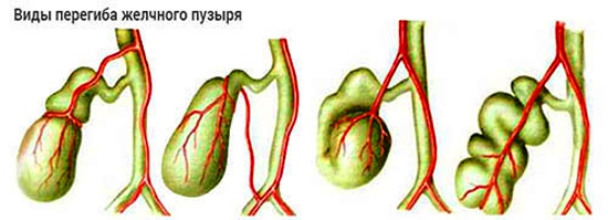 Перегиб желчного пузыря как снять боль thumbnail