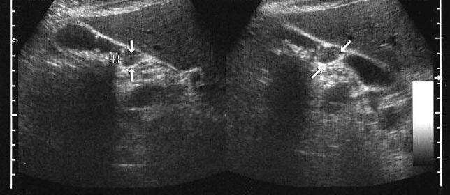 Перегиб желчного пузыря на УЗИ