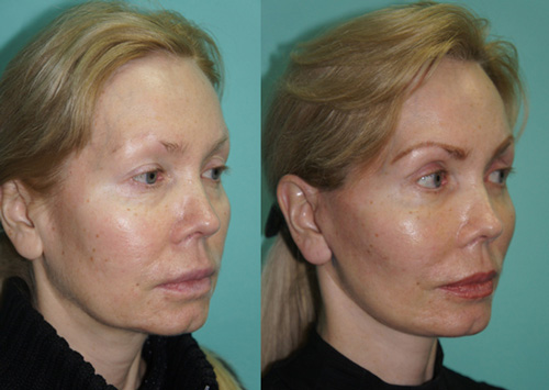 Фото до и после эндоскопического лифтинга лица