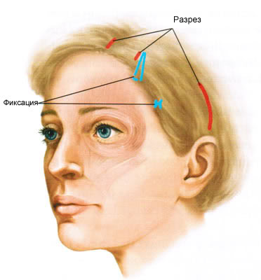 Схема разрезов при эндоскопической подтяжке лица