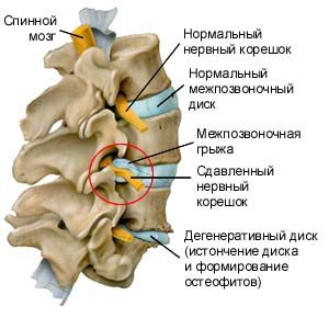 Чем опасна межпозвоночная грыжа шейного отдела?