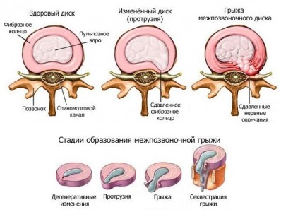 Виды межпозвонковой грыжи шейного отдела