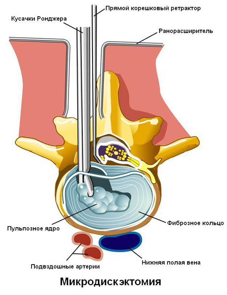 Микродискэктомия