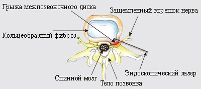 Перкутанная лазерная дискэктомия