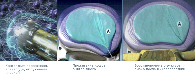 Холодноплазменная коблация (нуклеопластика)