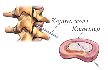 Методы хирургическое лечение межпозвоночных грыж thumbnail