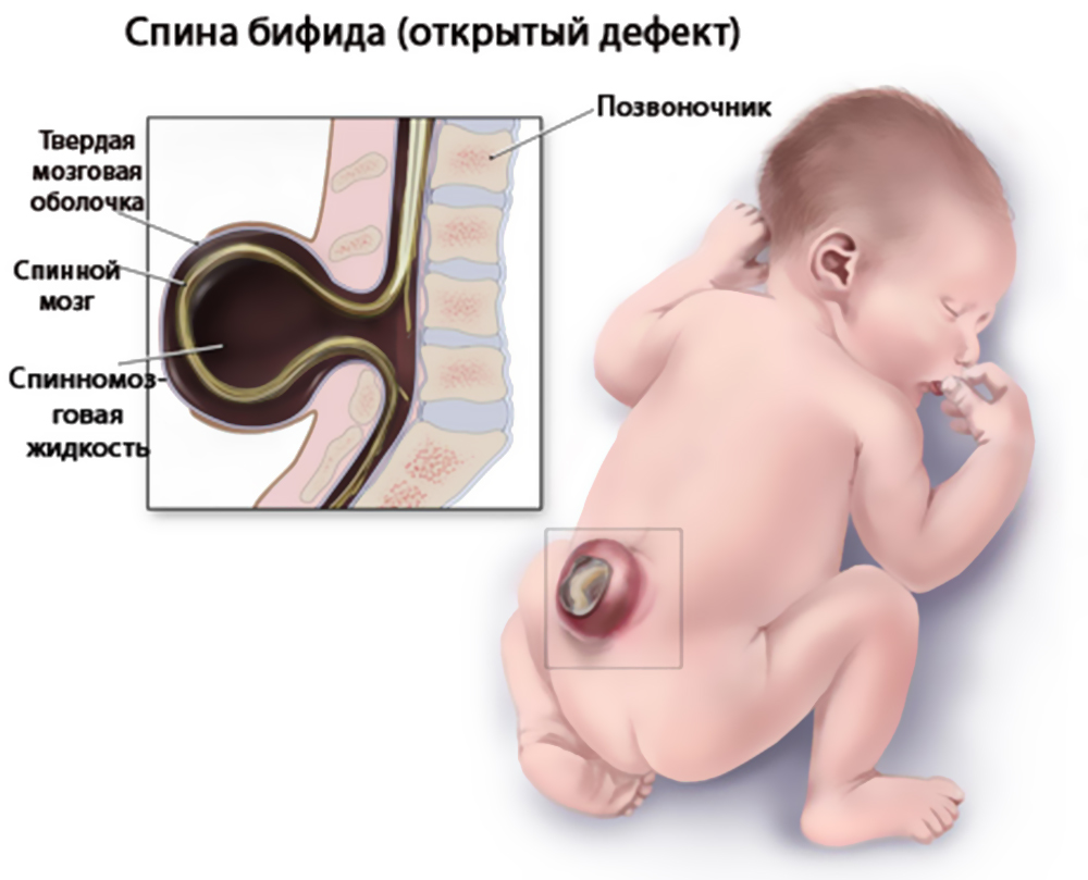 Врожденное расщепление позвоночника и спинномозговая грыжа