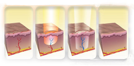 Лазерное удаление сосудистой сеточки