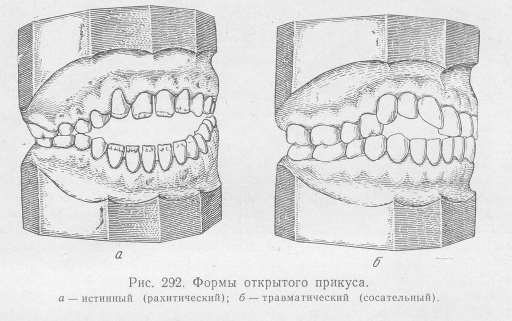 Открытый прикус