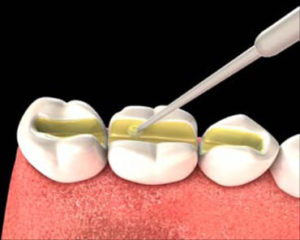 Шинирование зубов стекловолокном
