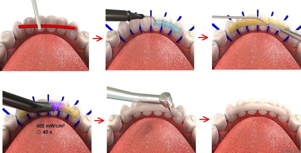 Способы шинирования зубов в стоматологии
