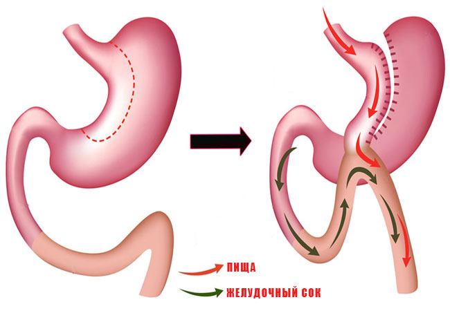 Шунтирование желудка