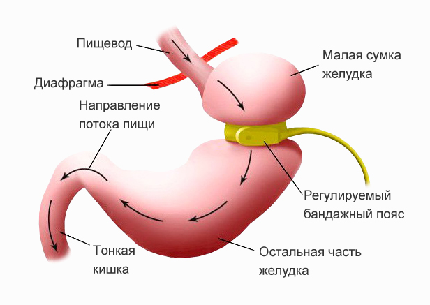 Бандажирование желудка