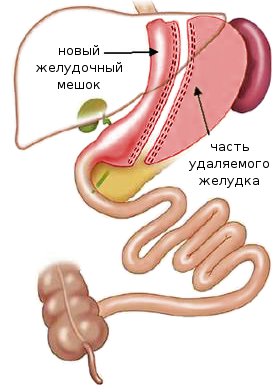 Резекция желудка