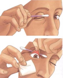 Лечение после извлечения тела из глаза thumbnail