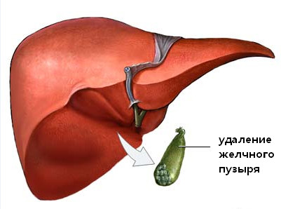 Удаление желчного пузыря при дискинезии