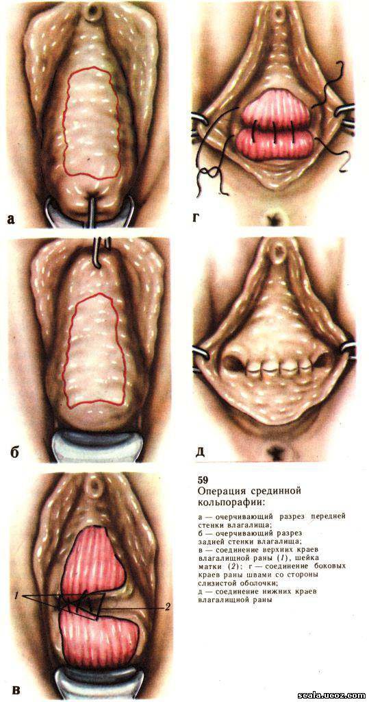 Срединная кольпорафия