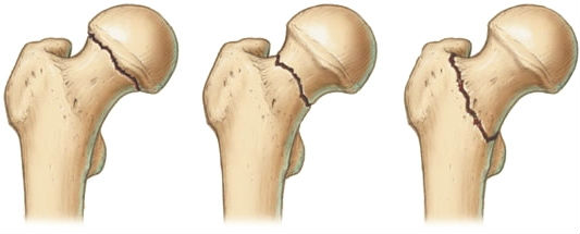 Виды переломов шейки бедра
