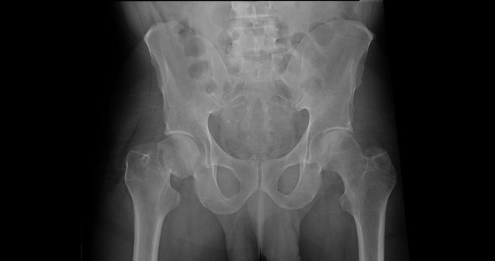 Перелом шейки бедра справа на рентгенограмме
