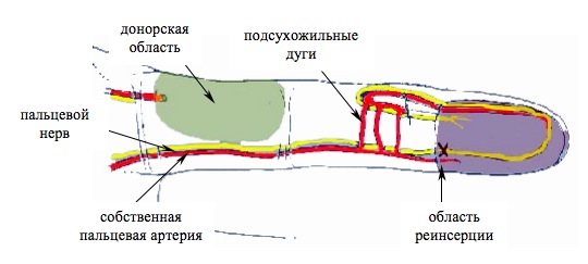 Васкуляризованная кожная пластика