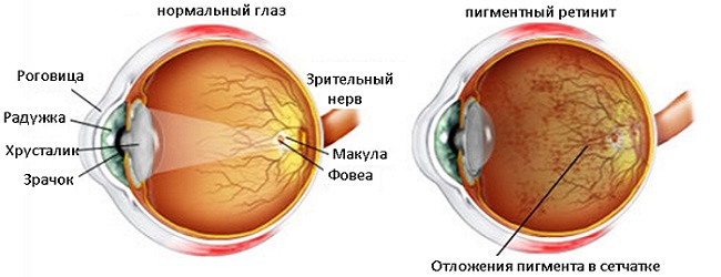 Абиотрофия сетчатки