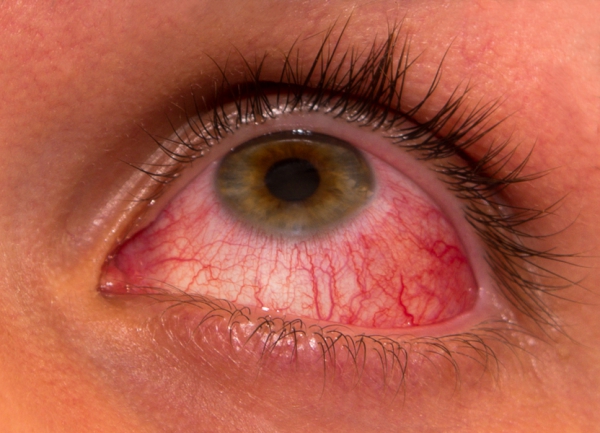 Красные глаза - симптом каких болезней?