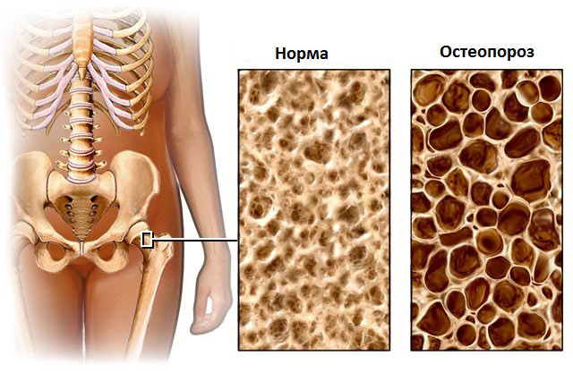Денситометрия в диагностике остеопороза