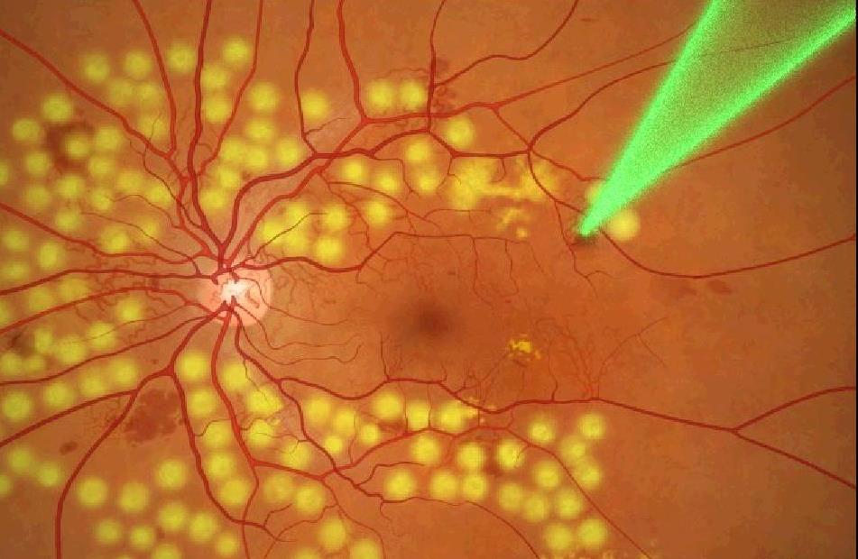 Диагностика и лечение диабетической ретинопатии