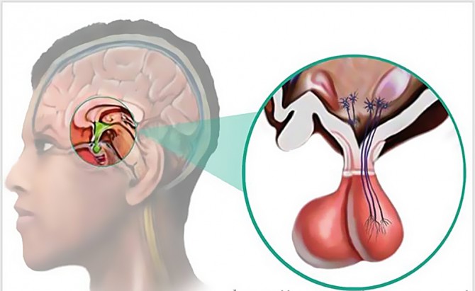 Симптомы аденомы гипофиза