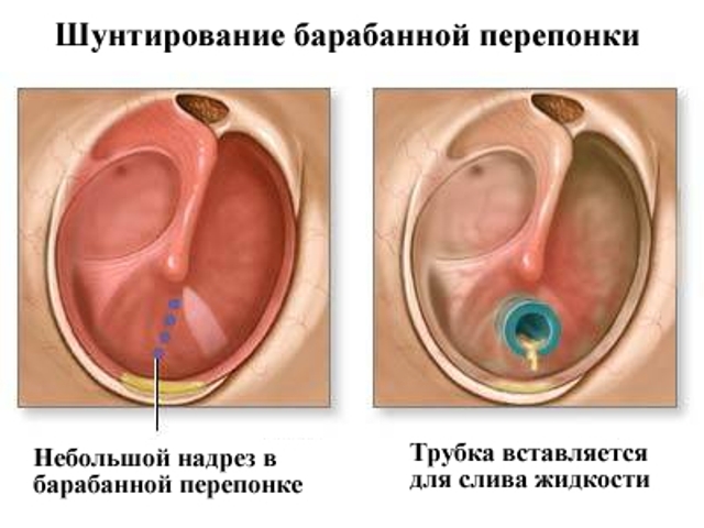 Парацентез и шунтирование барабанных перепонок