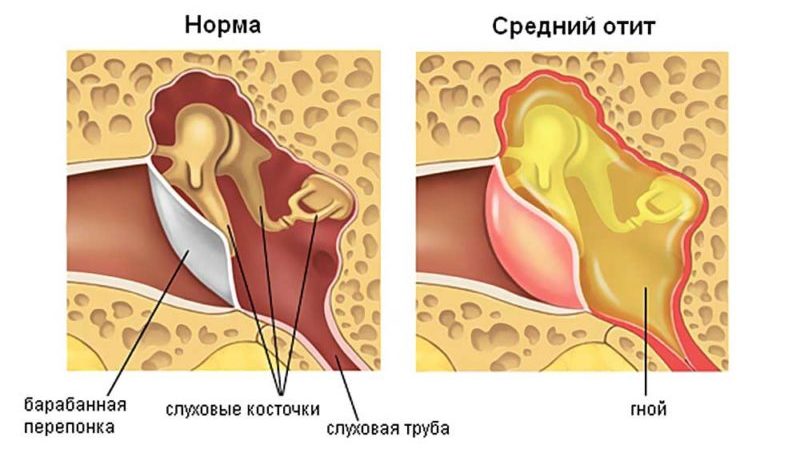 Парацентез и тимпанопункция барабанных перепонок