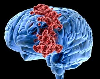 Признаки и причины рака головного мозга