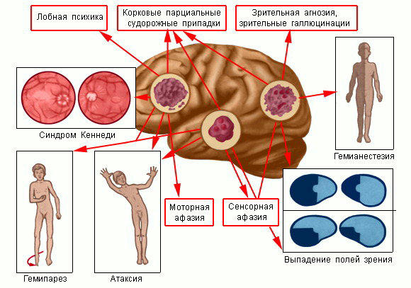 Ранние симптомы рака головного мозга