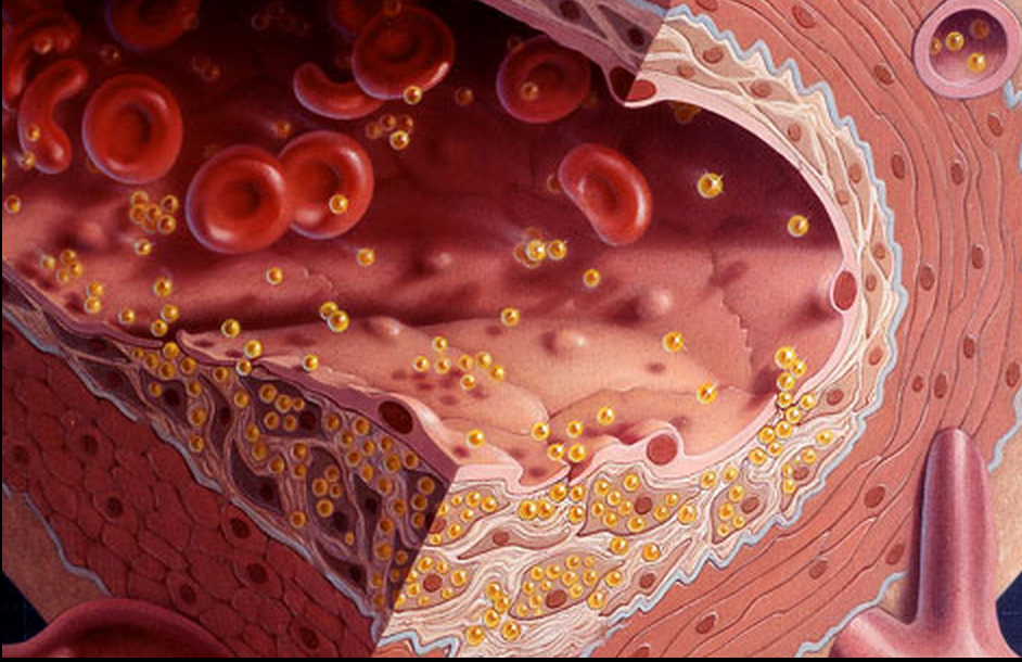 Атеросклероз - типы атеросклероза, симптомы и риски