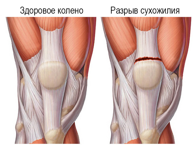 Травма связочного аппарата коленного сустава