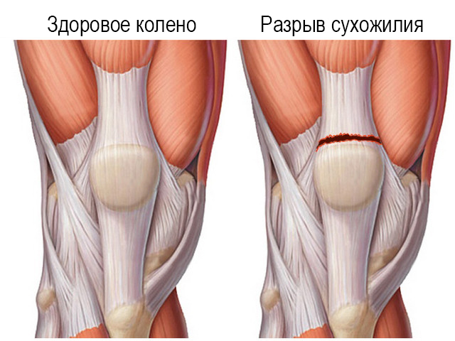 Изображение - Ушиб коленного сустава у пожилых людей vidy-zakrytyx-travm-kolena-simptomy-travm-kolennogo-sustava-1