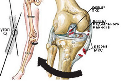 Изображение - Травма коленного сустава первая помощь vidy-zakrytyx-travm-kolena-simptomy-travm-kolennogo-sustava-3