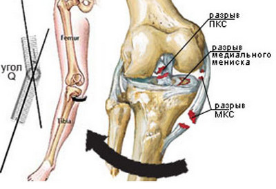 Повреждение мениска