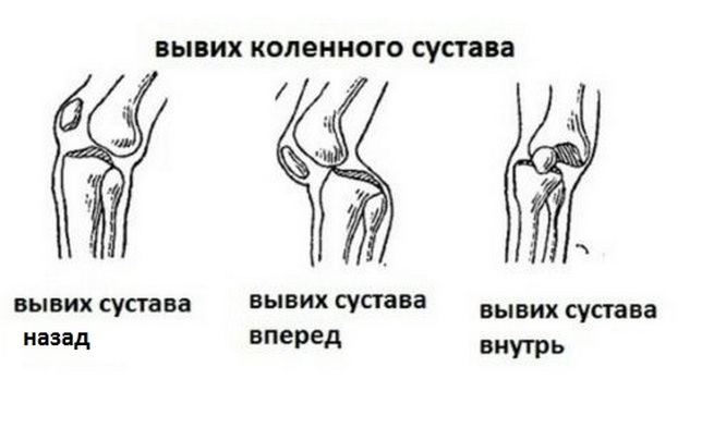 Изображение - Повреждения коленного сустава травматология vidy-zakrytyx-travm-kolena-simptomy-travm-kolennogo-sustava-4